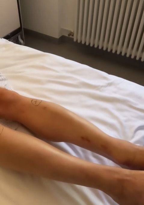 Jovem modelo mostra em suas redes sociais, como foi o procedimento para ganhar 14 cm.