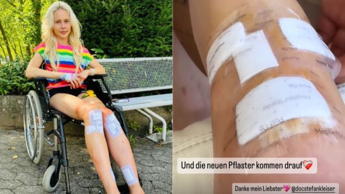 Mulher agora vai precisar andar de muletas, até ser liberada.