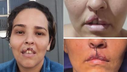 Mulher tem lábio arrancado por cachorro e passa por cirurgia de reconstrução.