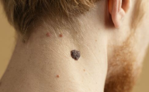 Pintas podem servir de alerta para problemas de pele