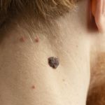 Quando uma pinta se torna sinal de alerta? Dermatologista explica