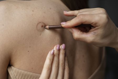 Pintas são lesões benignas na pele