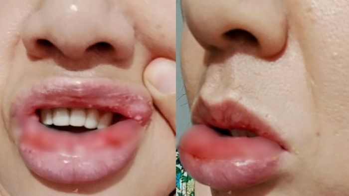 Mulher que teve lesão na boca após usar creme dental quer processar Colgate | CNN Brasil