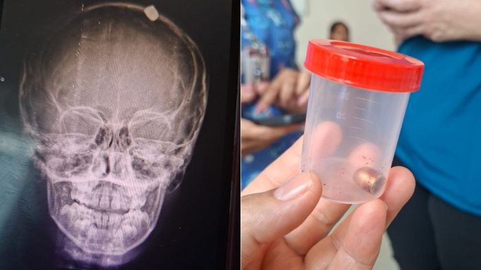 Raio-x mostra projétil no crânio de criança atingida por bala perdida no Ano-Novo, na Grande BH Raio-x mostra projétil no crânio de criança atingida por bala perdida no Ano-Novo, na Grande BH