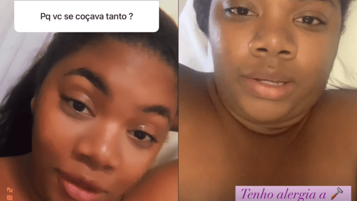 Raquel Brito esclareceu a coceira no Instagram