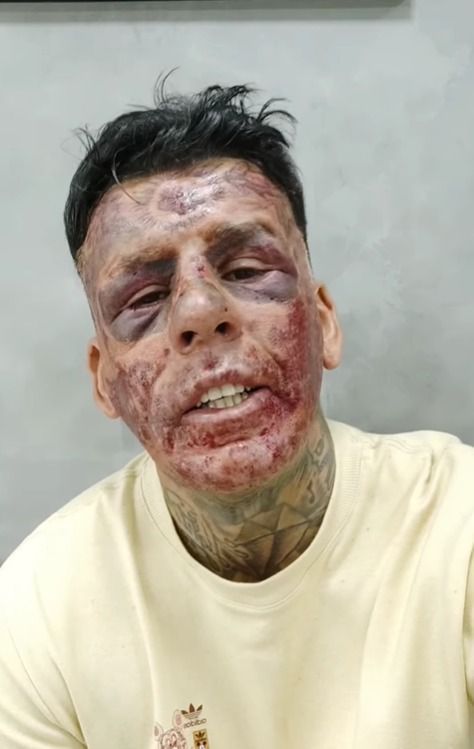 Para conseguir se reestabelecer, Leandro começou a usar as redes sociais para pedir ajuda financeira. Para conseguir se reestabelecer, Leandro começou a usar as redes sociais para pedir ajuda financeira.