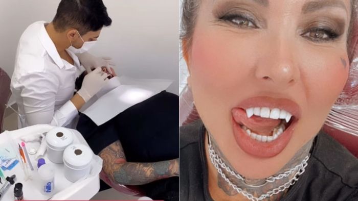 Após colocar 6 litros de silicone, Sabrina Boing Boing troca dentes por 'presas felinas'.