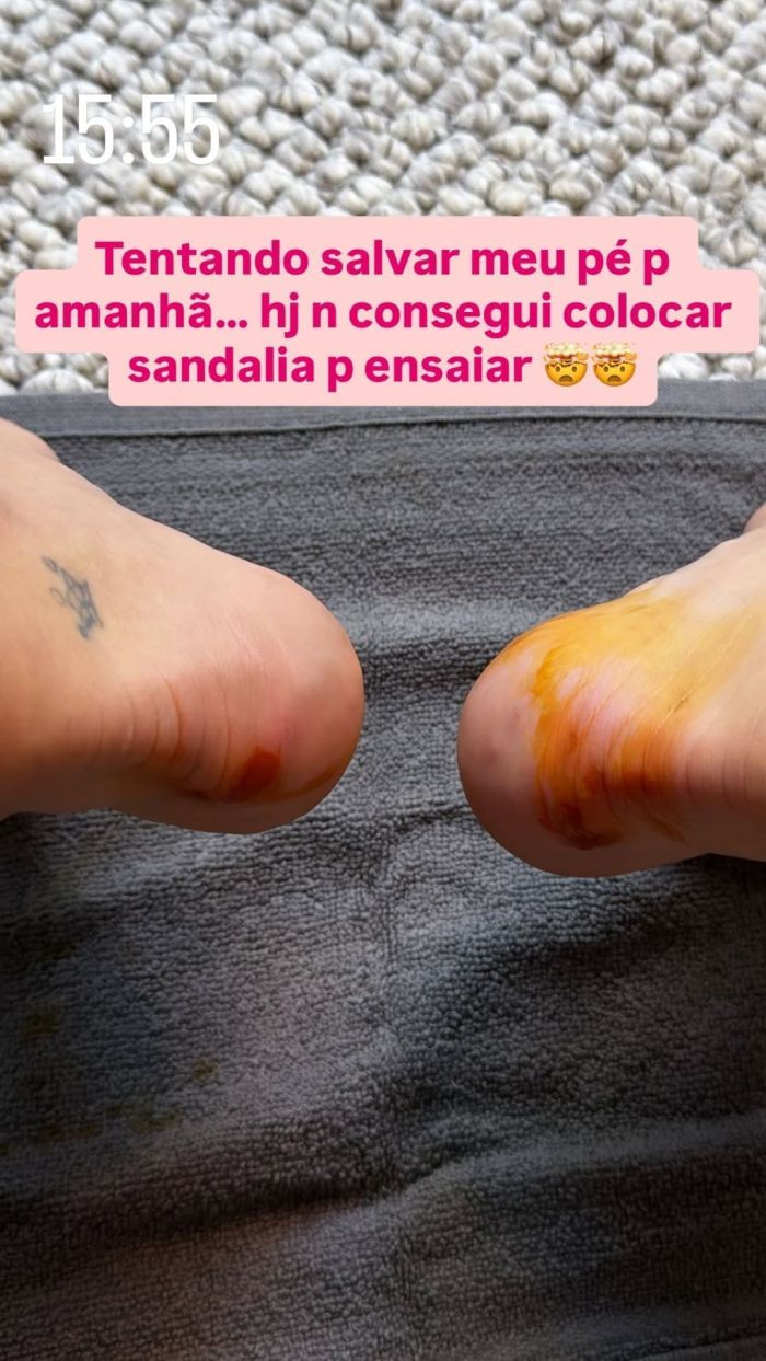 Virginia Fonseca mostra pés machucados nas redes sociais