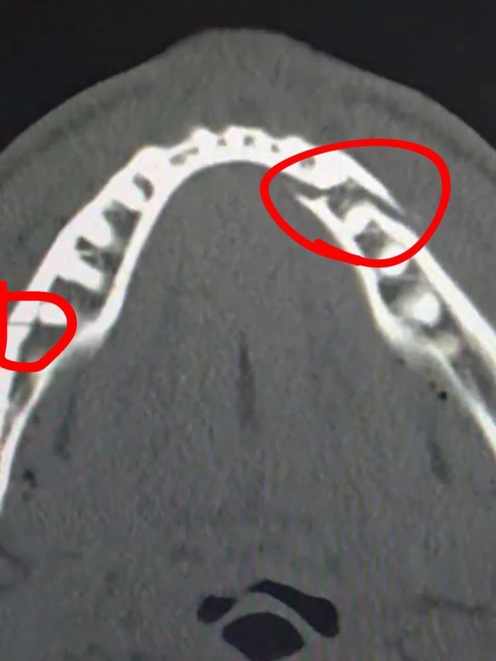 Raio-x da mandíbula de Jake Paul após luta contra Anthony Joshua