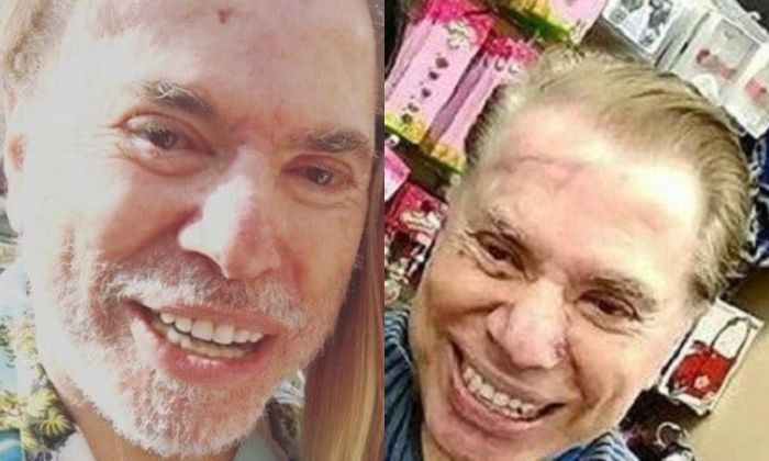 Silvio Santos removeu um tumor na testa após diagnóstico de câncer de pele