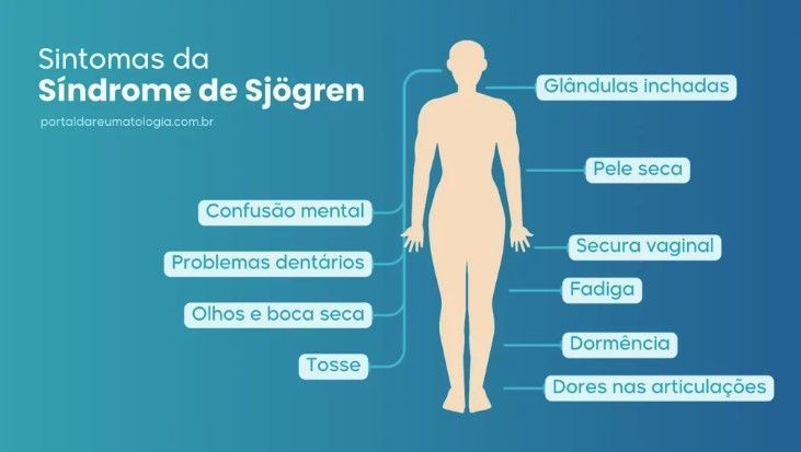 Fabiana de Lemos | Quero chorar, mas não tenho lágrimas; conheça a síndrome de Sjögren