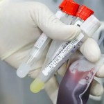 Teste rápido na detecção da febre bubônica é avaliado em campo