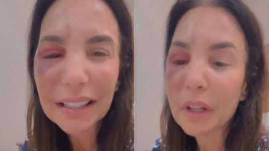 Ivete Sangalo passou por cirurgia delicada no domingo após quebrar dois ossos da face