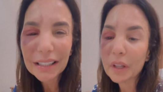 Ivete Sangalo passou por cirurgia delicada no domingo após quebrar dois ossos da face