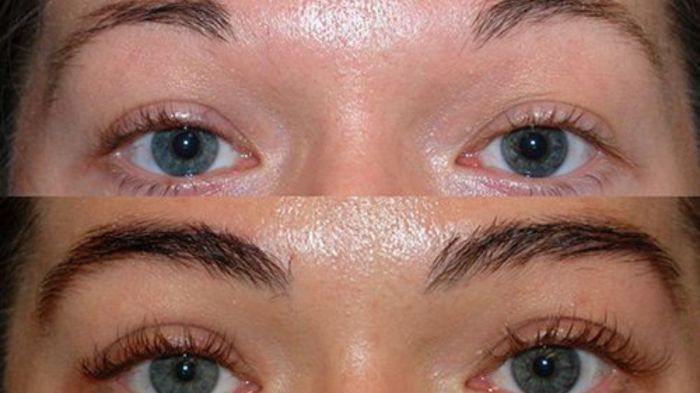 Transplante de Sobrancelhas e Capilar Estética com Propósito e Naturalidade