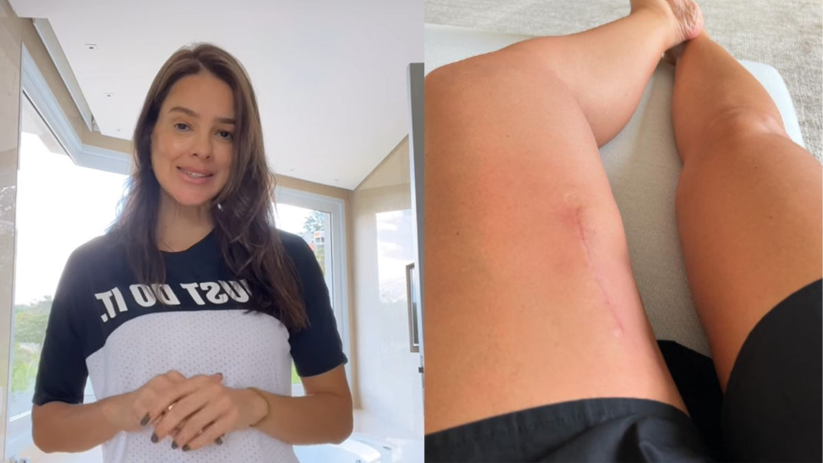 Após retirada de tumor raro, Vera Viel faz reflexão ao exibir cicatriz de cirurgia