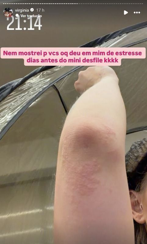 Virginia exibiu reação da pele causada por estresse