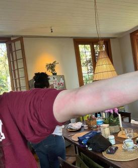 Mayana mostra os resultado das alergias pelo corpo