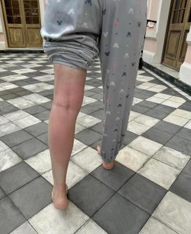 Mayana mostra os resultado das alergias pelo corpo
