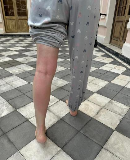 Mayana mostra os resultado das alergias pelo corpo
