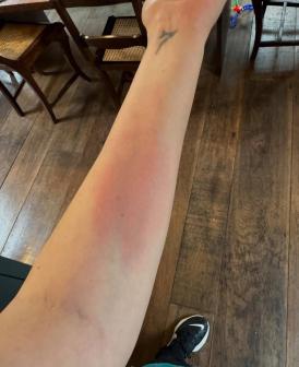 Mayana mostra os resultado das alergias pelo corpo