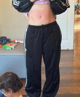 Mayana mostra os resultado das alergias pelo corpo