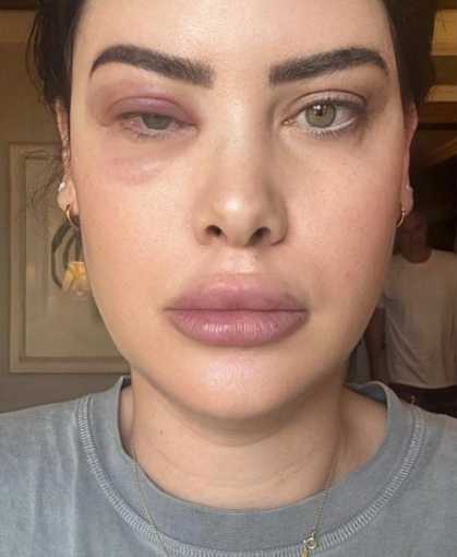 Mayana mostra os resultado das alergias pelo corpo