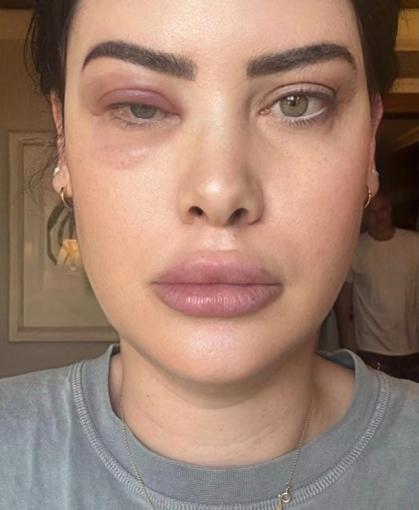 Mayana mostra os resultado das alergias pelo corpo