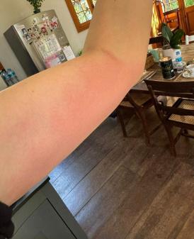 Mayana mostra os resultado das alergias pelo corpo