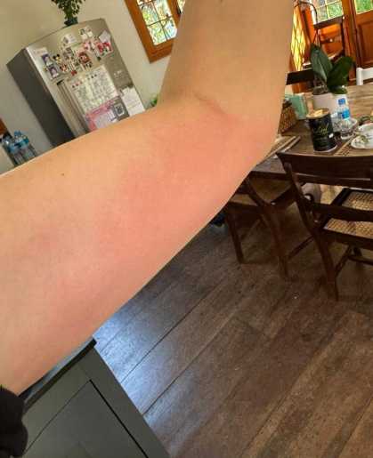 Mayana mostra os resultado das alergias pelo corpo