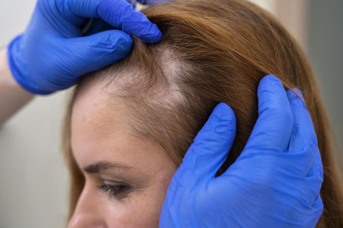 Alopecia androgenética feminina