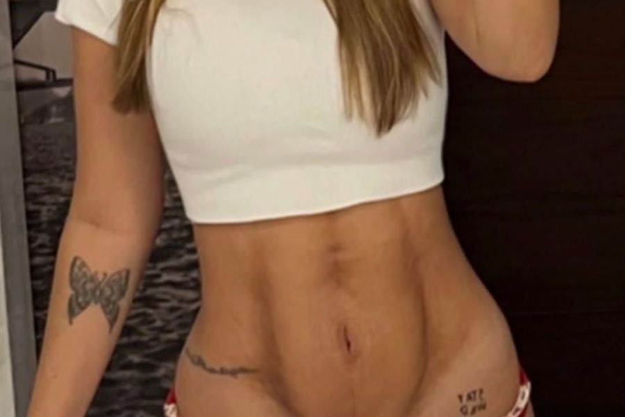 Especialista avalia caso de influenciadora com necrose pós-cirurgia