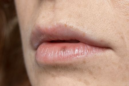 Herpes labial