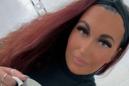 Paciente descobriu meningioma escondido atrás de cílios postiços