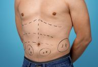 Homem também pode fazer lipoaspiração? Especialista explica cirurgia