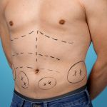 Homem também pode fazer lipoaspiração? Especialista explica cirurgia
