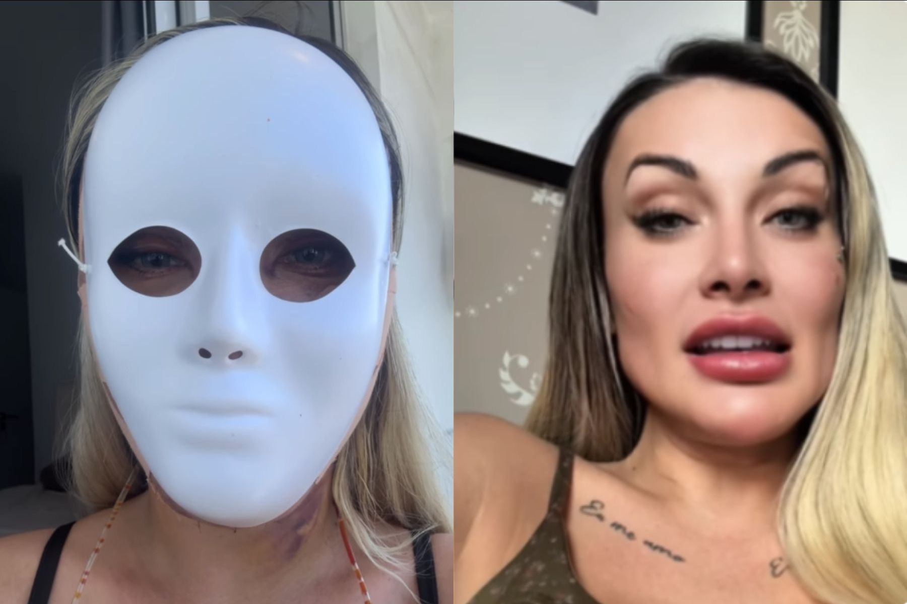 Andressa Urach faz nova cirurgia plástica e afirma: ‘Reencontro comigo’