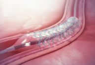 Estudo internacional aponta desafios de stents em pacientes com diabetes
