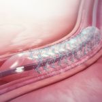Estudo internacional aponta desafios de stents em pacientes com diabetes