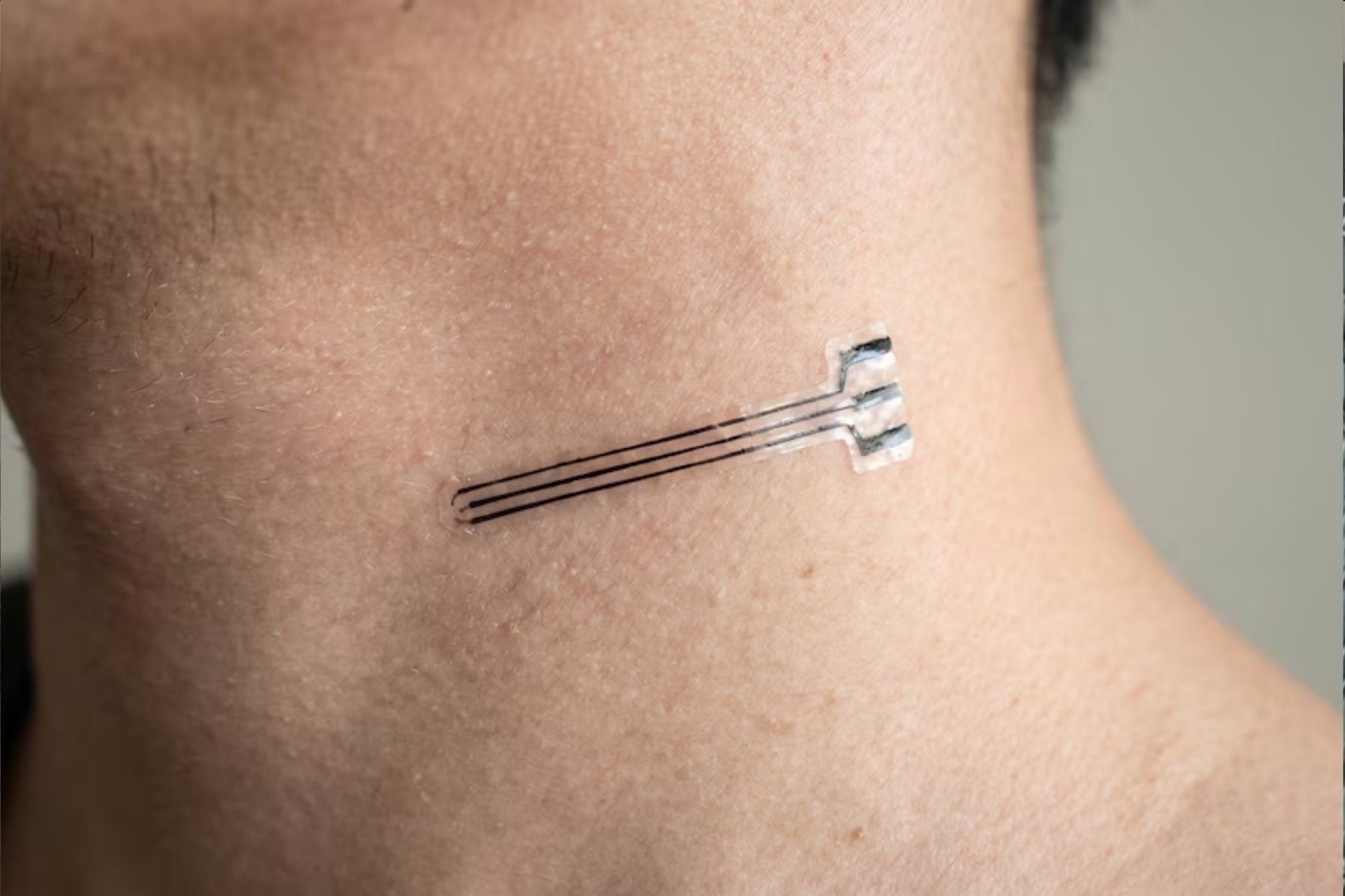 Sem pontos cirúrgicos: implante elástico inovador transforma tratamento da hipertensão