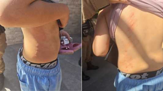 Padrasto é preso suspeito de espancar enteado que teve fratura facial em BH