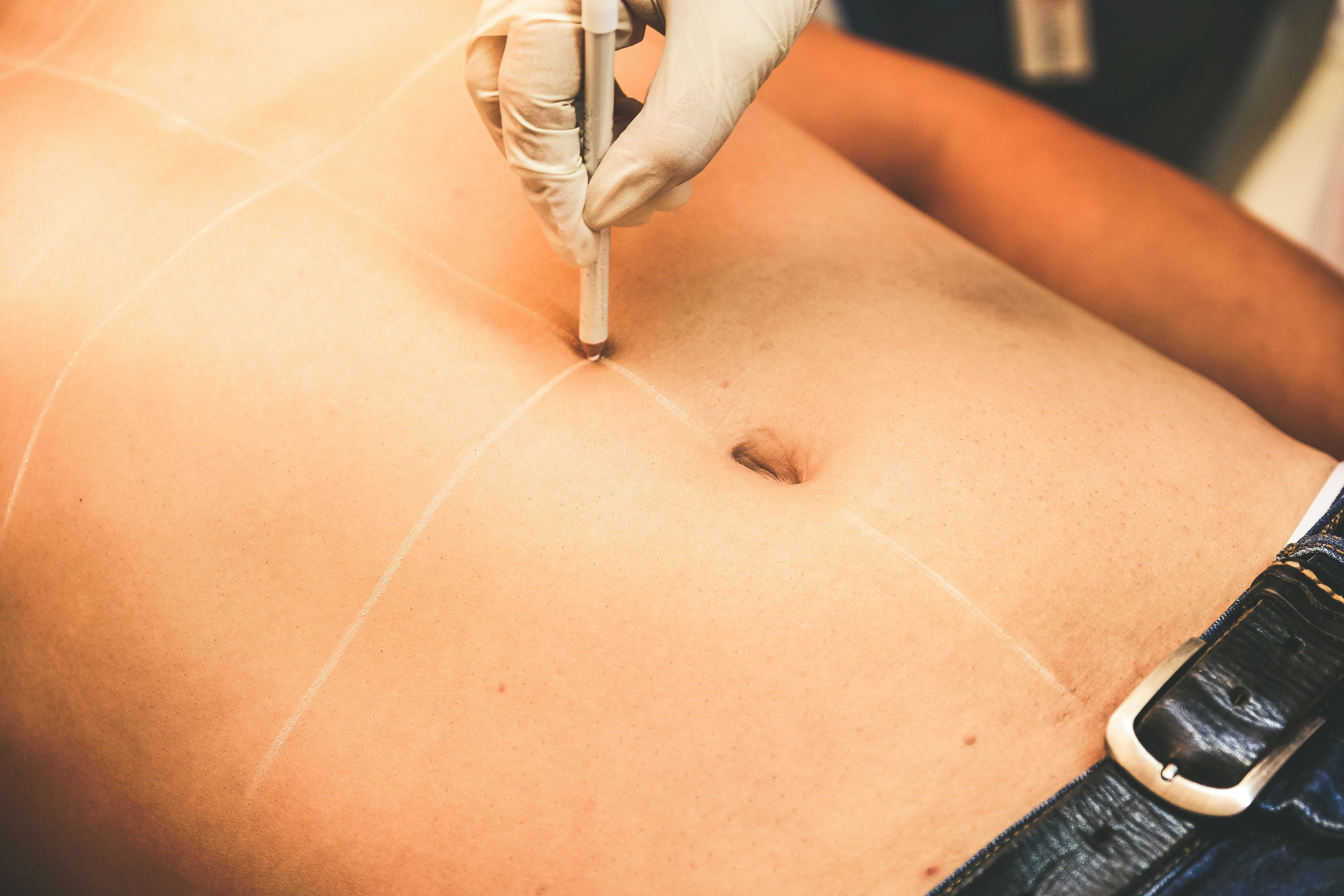 Abdominoplastia: uso inadequado da cinta pode causar necrose, alerta especialista