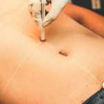 Abdominoplastia: uso inadequado da cinta pode causar necrose, alerta especialista