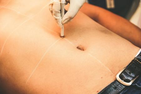 Abdominoplastia