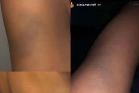 Jelicia Westhoff mostrou machucados ao acusar Maduka Okoye de violência doméstica • Reprodução | Redes Sociais