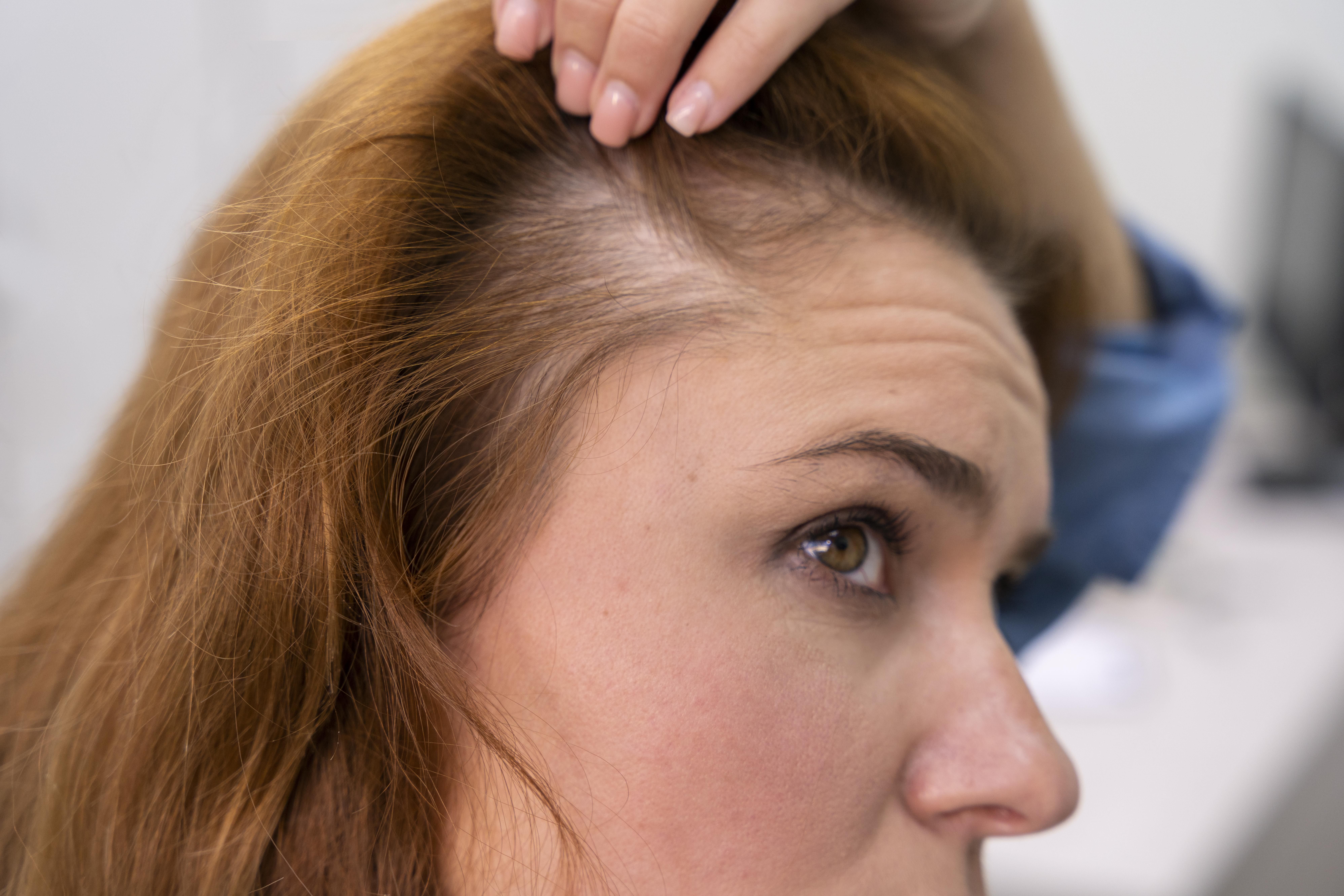 Mulheres também podem desenvolver calvície? Especialista responde