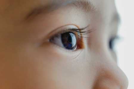Glaucoma em crianças