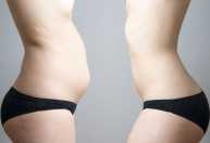 Gordura abdominal: o que fazer para perder barriga de forma saudável