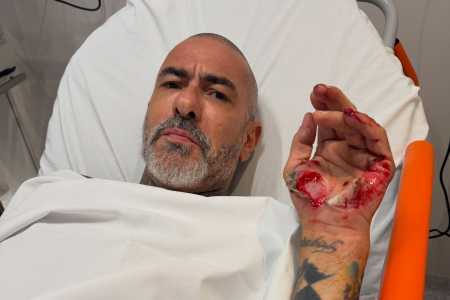 Henrique Fogaça mostrou ferimentos de acidente