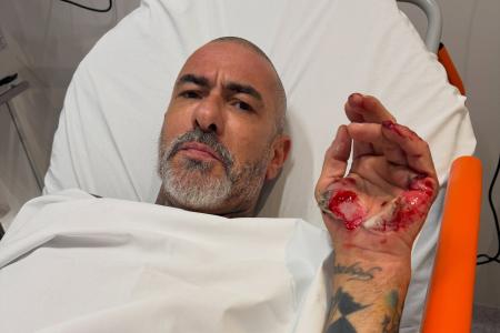 Henrique Fogaça mostrou ferimentos de acidente